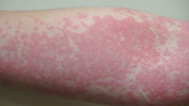فيروس كورونا: الطفح الجلدي يمكن أن يكون العرض الوحيد لعدوى كوفيد-19..