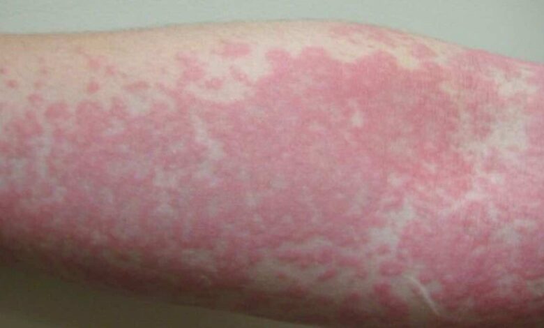 فيروس كورونا: الطفح الجلدي يمكن أن يكون العرض الوحيد لعدوى كوفيد-19..