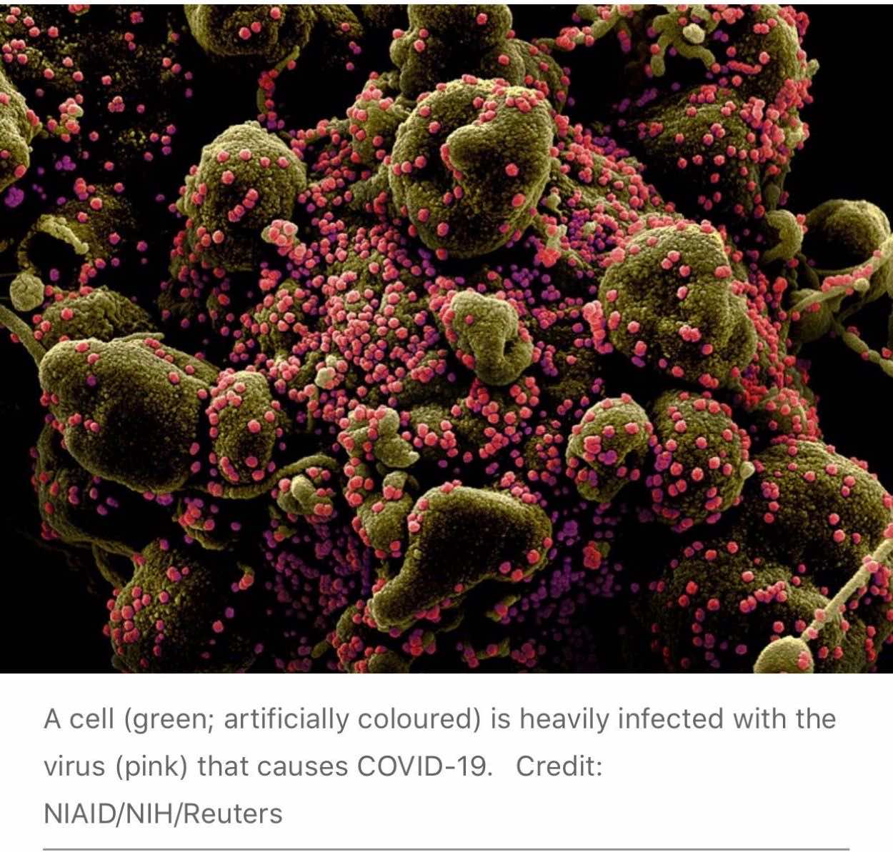 خلية بشرية (باللون الأخضر ) تغزوها بكثافة جسيمات فيروس كورونا (باللون الزهري)