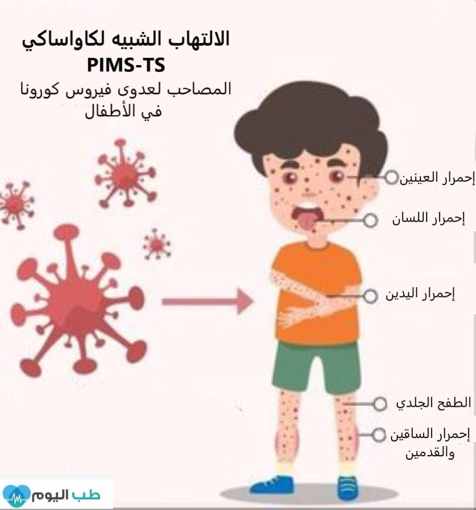 أعراض الالتهاب المشابه لكاواساكي والمصاحب لعدوى فيروس كورونا في الأطفال