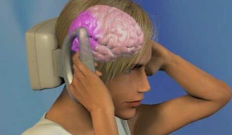 التنبيه المغناطيسي عبر الدماغ (transcranial magnetic stimulation (TMS) لعلاج الصداع النصفي