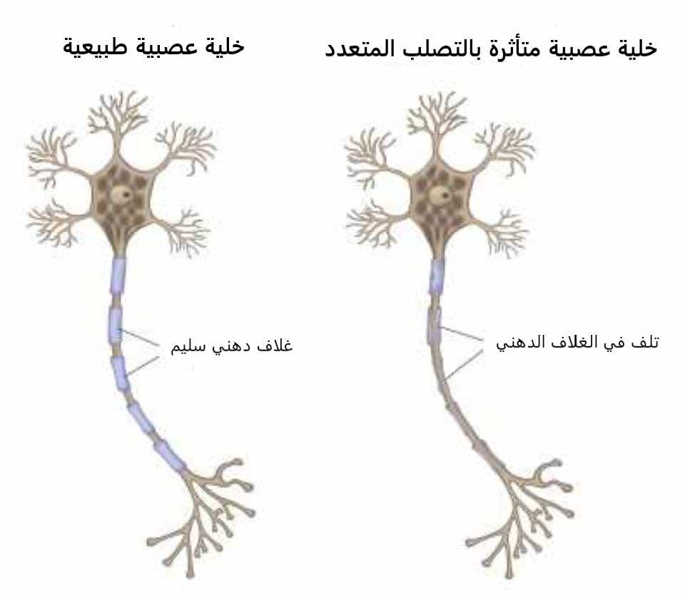 تأثر الخلية العصبية في مرض التصلب المتعدد