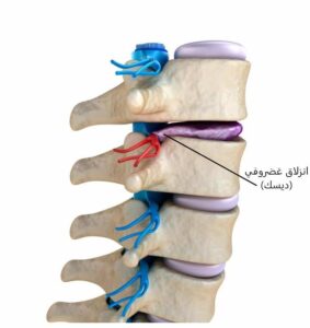 4 علامات قد تشير أن سبب آلام الظهر انزلاق غضروفي (ديسك) انزلاق غضروفي (ديسك)