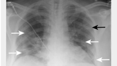 شرح مبسط لتغيرات أشعة الصدر ودورها في تشخيص عدوى كوفيد-19 بحسب التوصيات البريطانية: أشعة صدر لمريض كوفيد في يوم أول يوم من دخوله للمستشفى bmj