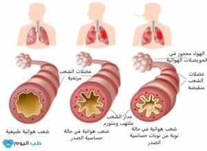 كيف تحدث ازمة الربو؟