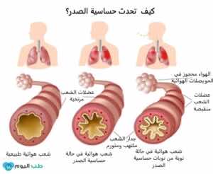 كيف تحدث حساسية الصدر؟