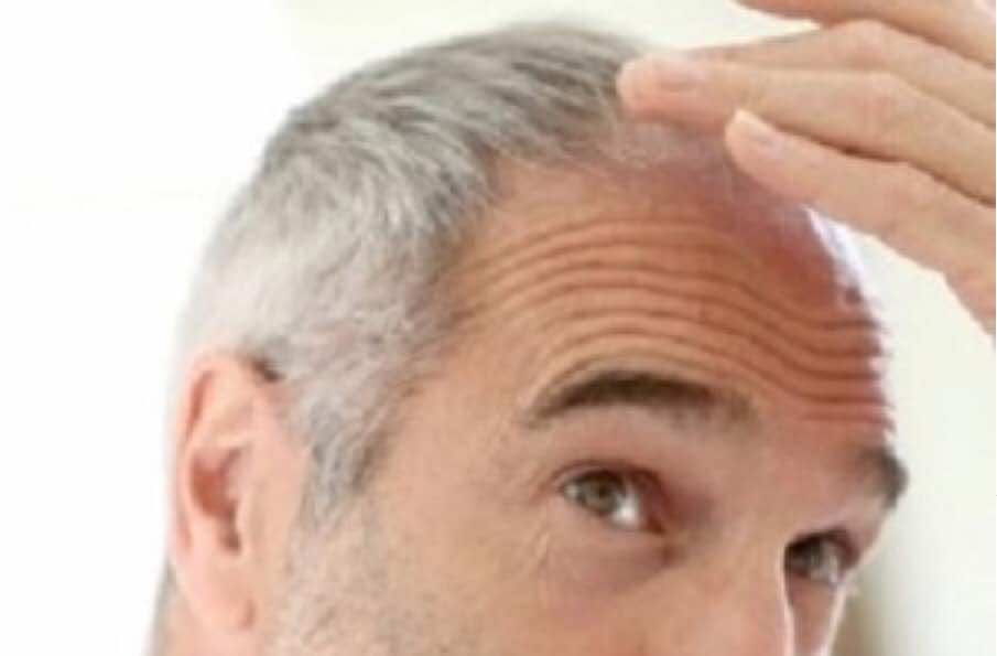 هل يرتبط ظهور الشعر الأبيض مبكرا باحتمالات أكبر لأمراض القلب؟