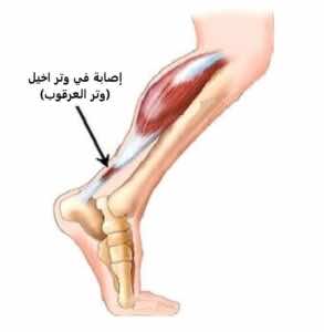 اصابة في وتر اخيل
