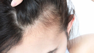 بنك المعرفة (6) | ما هو عدد شعرات فروة الرأس؟ وما عدد الشعرات التي تتساقط بشكل طبيعي يوميا؟