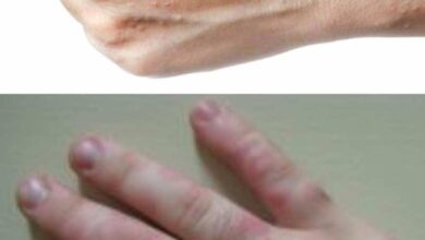 الارتيكاريا (بالأسفل) والاكزيما التأتبية (بالأعلى)