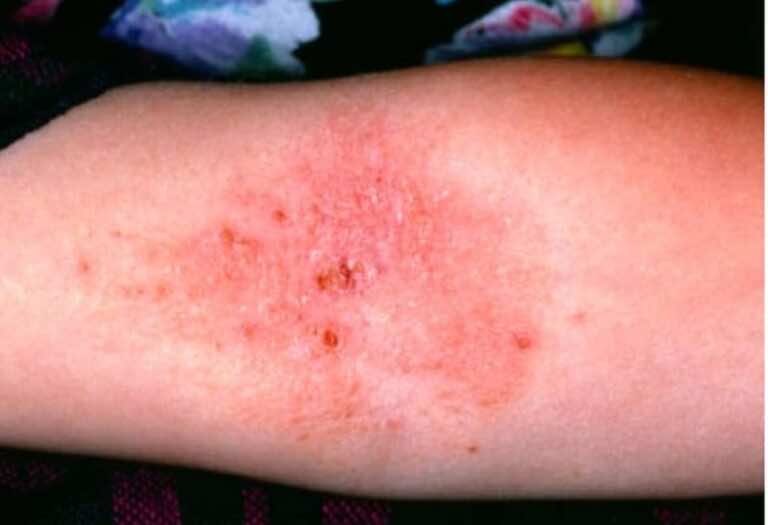 الارتيكاريا والاكزيما التأتبية نوعان من حساسية الجلد علاجهما مختلف..فما