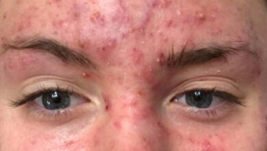 طب اليوم يستعرض معكم 5 معلومات خاطئة عن حب الشباب بحسب توصيات المستشفيات البريطانية