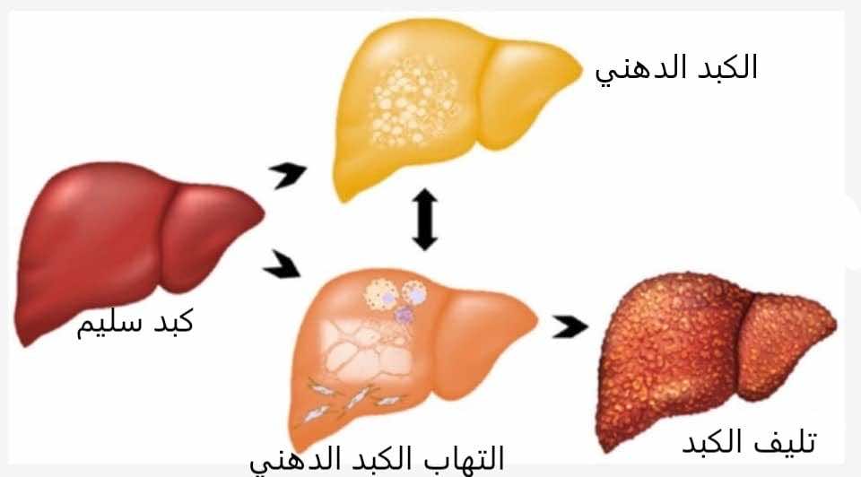 مرض الكبد الدهني