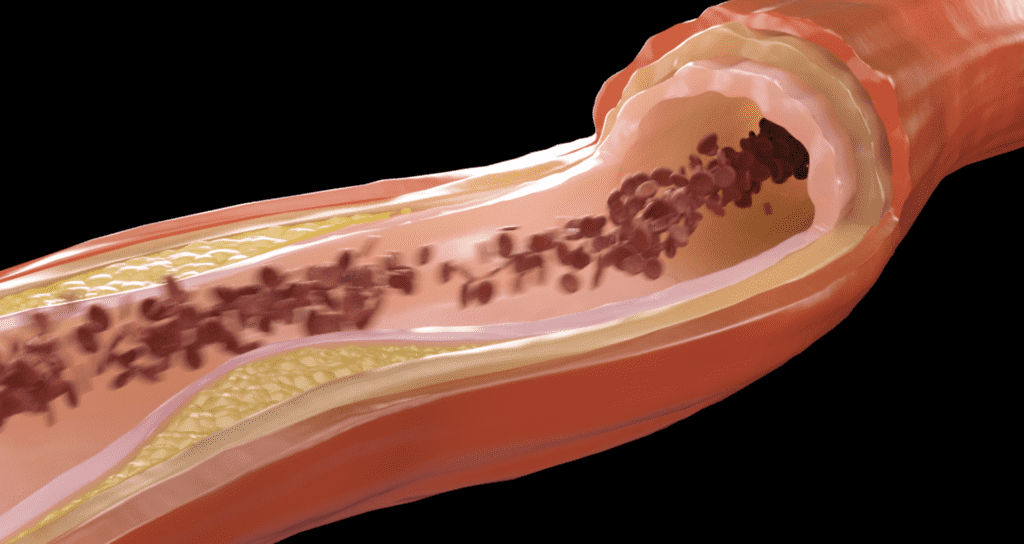 وعاء دموي يتضح فيه الترسبات الدهنية التي تسبب الضيق ونقص الإمداد الدموي للأنسجة التي يغذيها