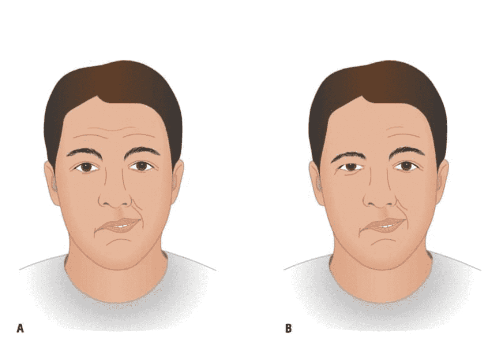 ما الفرق بين العصب السابع و تأثير السكتة الدماغية الخطيرة على الوجه؟