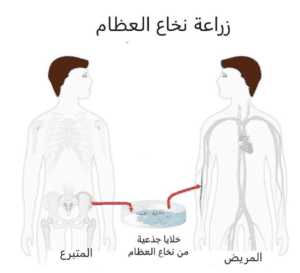 زراعة نخاع العظم - علاج انيميا البحر المتوسط