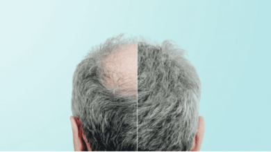 زراعة الشعر في بريطانيا : نوعان من العمليات.. فكم التكلفة؟ وما هي المخاطر؟ - تساقط الشعر