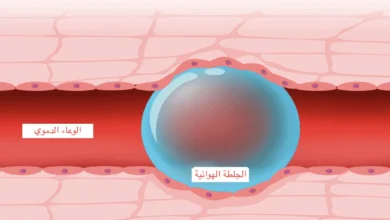 متى تكون حقنة الهواء مميتة؟ وما هي الجلطة الهوائية؟