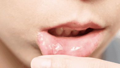 فيزيتا مجانية | 7 علامات تجعل قرحة الفم تستلزم زيارة طبيب الاسنان والفم للاطمئنان