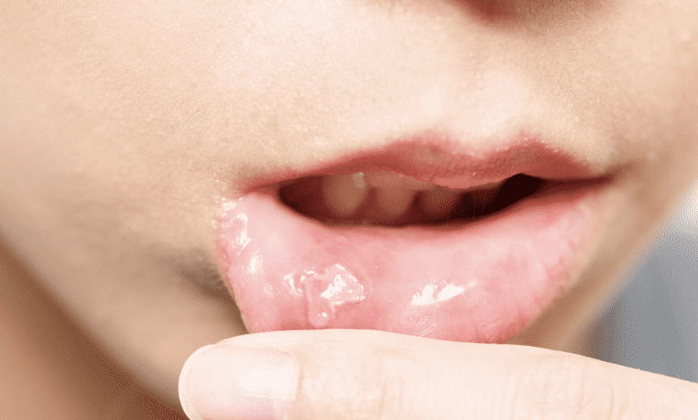 فيزيتا مجانية | 7 علامات تجعل قرحة الفم تستلزم زيارة طبيب الاسنان والفم للاطمئنان