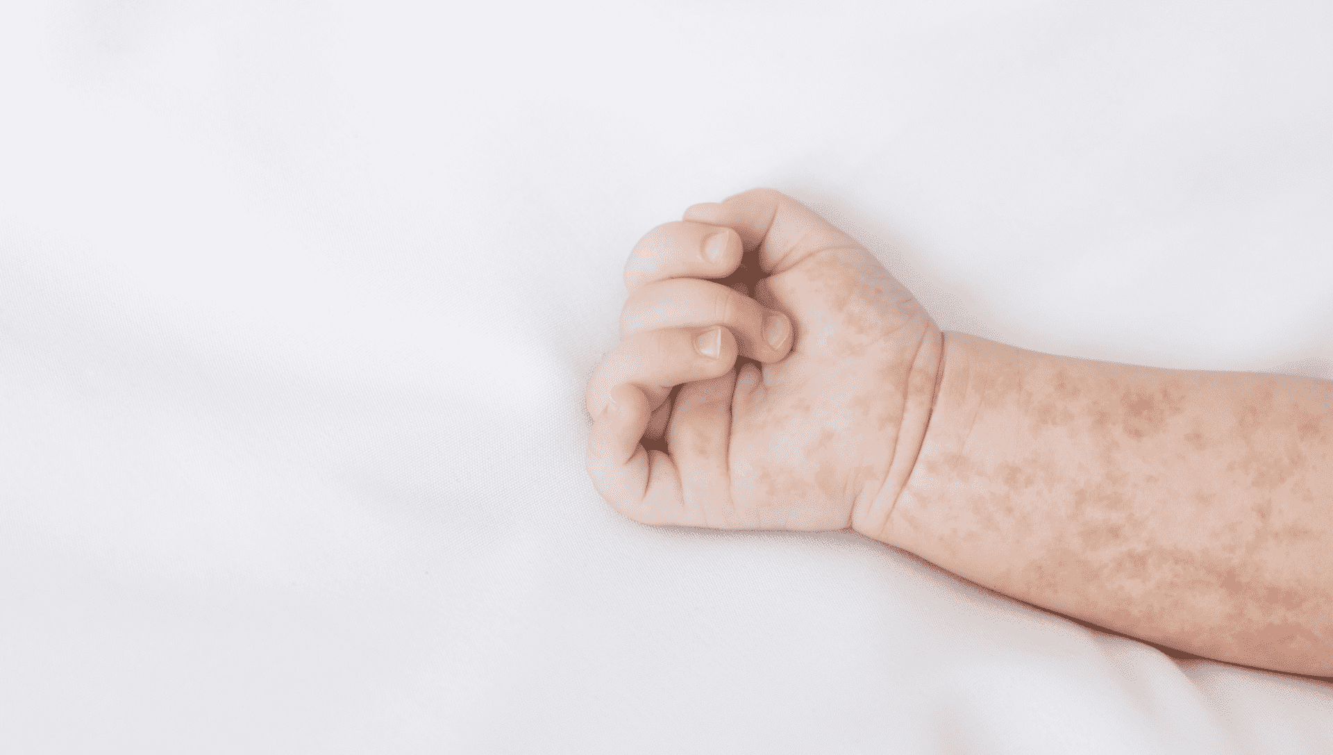 الطفح الجلدي عند الاطفال | 7 علامات تستلزم اللجوء ل مستشفى طواريء للاطمئنان