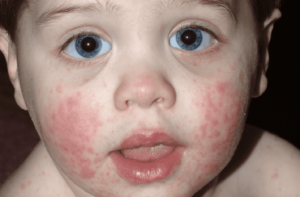 مرض الخد الصفعي  slapped cheek syndrome  ويسمى أيضا المرض الخامس Fifth disease - الطفح الجلدي عند الاطفال
