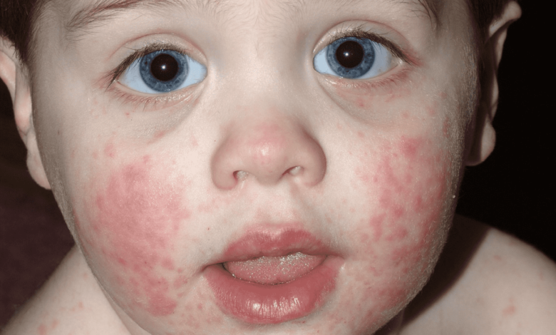  الطفح الجلدي عند الاطفال  | 5 أنواع يصاحبها ارتفاع في درجة الحرارة - بالصور - مرض الخد الصفعي - مرض اليد والقدم والفم - الطفح الوردي - الحمى القرمزية - الحصبة