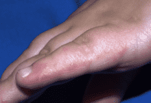 يعتبر مرض اليد والقدم والفم Hand, foot and mouth disease