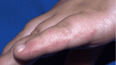 يعتبر مرض اليد والقدم والفم Hand, foot and mouth disease