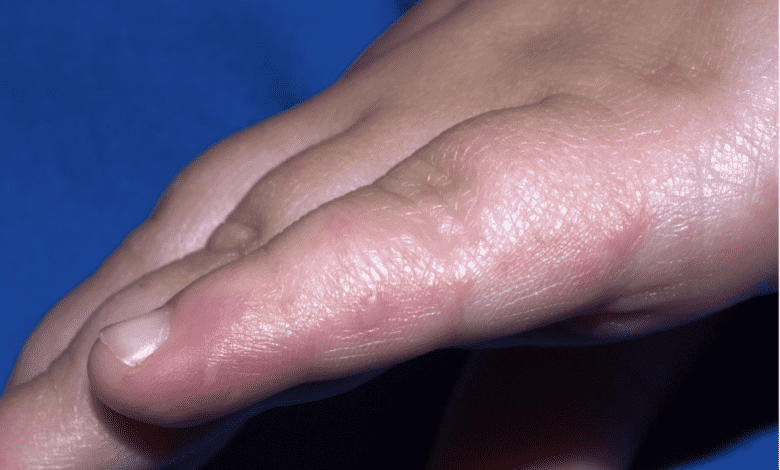 يعتبر مرض اليد والقدم والفم Hand, foot and mouth disease