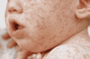 الحمى القرمزية Scarlet fever - الطفح الجلدي عند الاطفال - nhs