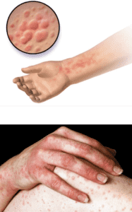 تظهر الارتيكاريا في شكل أشكال دائرية محددة صغيرة او كبيرة مرتفعة عن سطح الجلد أو بثور حمراء صغيرة وفي كل الأحوال تصاحبها حكة allergycliniclondon - nhs