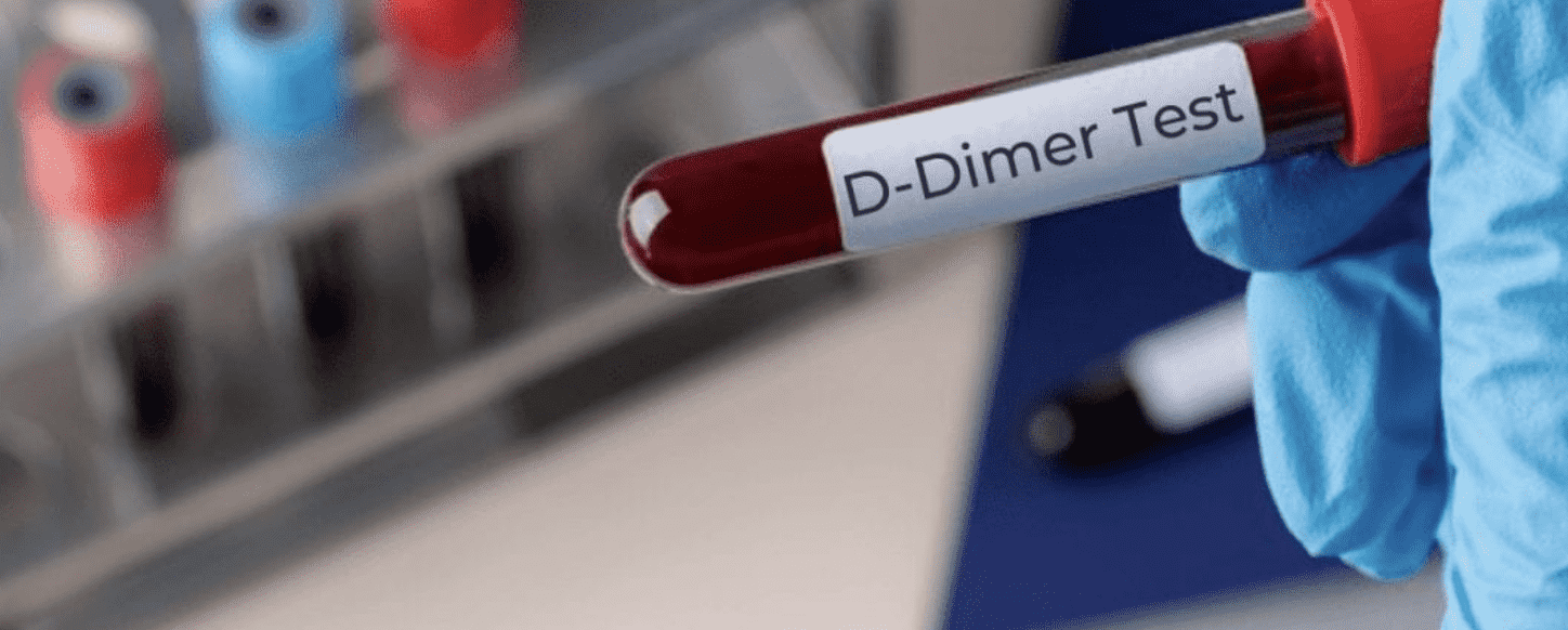استمرار ارتفاع دي دايمر d dimer لأشهر بعد التعافي من  كوفيد-19.. فما السبب؟ - تفاصيل الدراسة 
