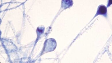 3 حالات من الفطر الاسود في منطقة الخليج العربي -وزارة الصحة