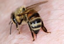 لسعة النحل - لدغة الحشرات | 7 اسعافات أولية 