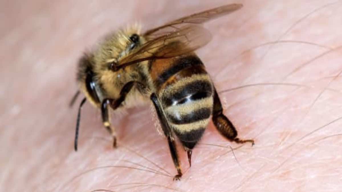 لسعة النحل - لدغة الحشرات | 7 اسعافات أولية 