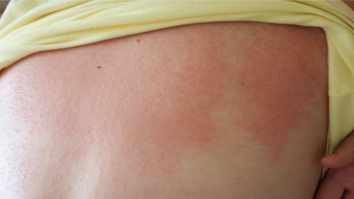 طفح جلدي عند الاطفال مع حكة 7 اسباب رئيسية (بالصور) طب اليوم