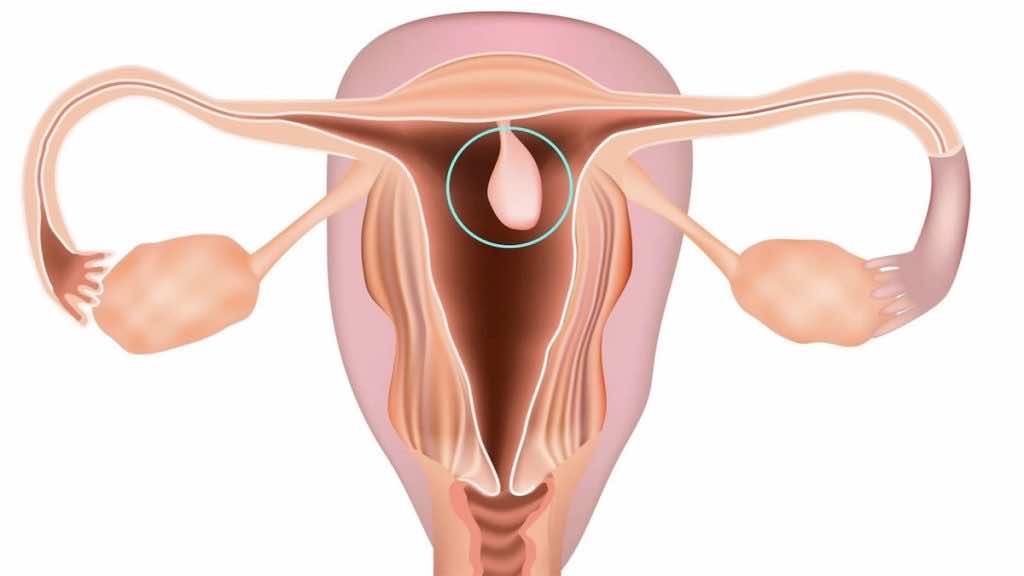 سلائل الرحم endometrial polyp هي أحد أسباب النزف بعد انقطاع الطمث
