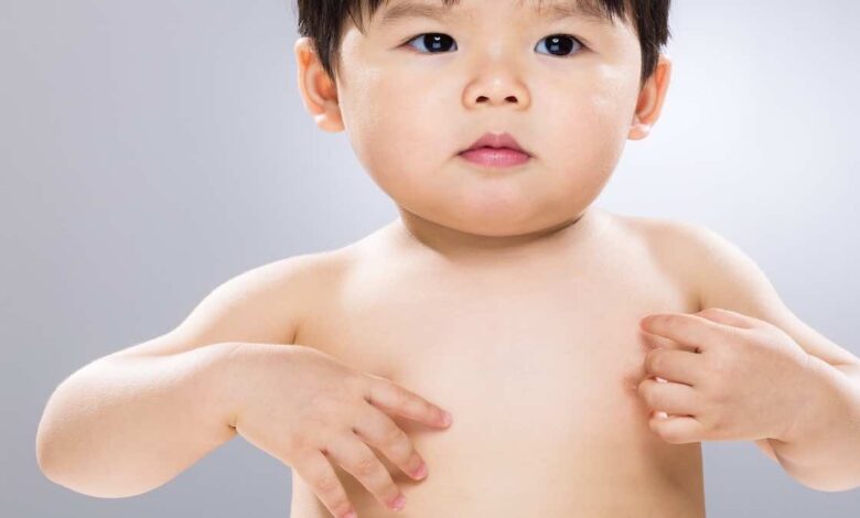 طفح جلدي عند الاطفال مع حكة | 7 اسباب رئيسية  (بالصور)