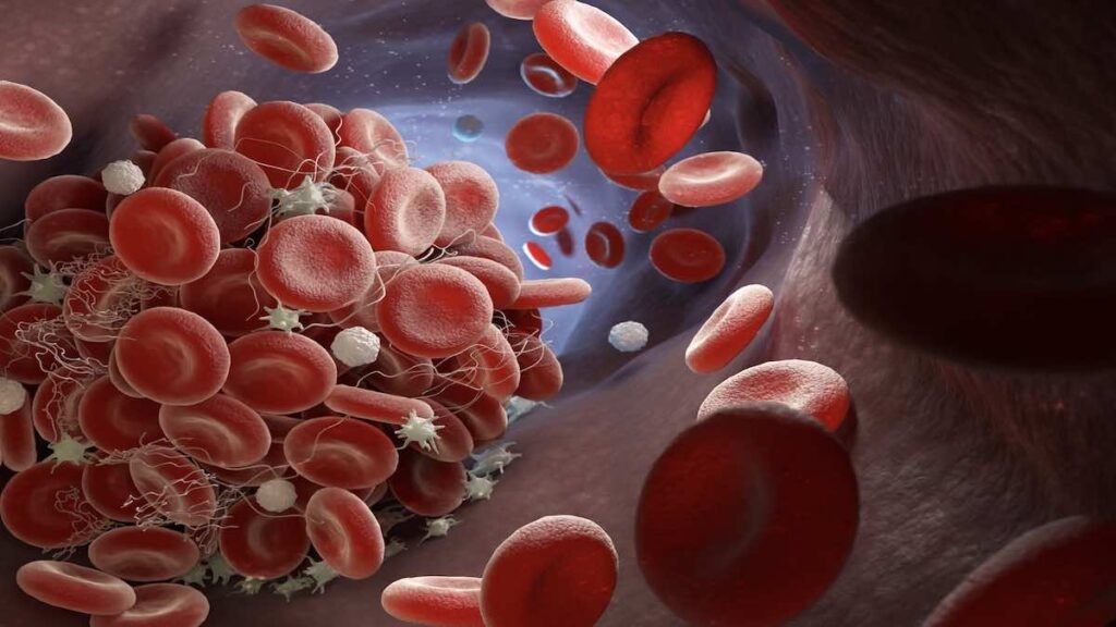  الجلطة الدموية ويظهر فيها كريات الدم الحمراء والصفائح الدموية الصغيرة ذات الاطراف بداخلها وبعض خلايا الدم البيضاء أيضا