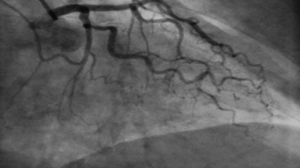 رسم الشريان التاجي coronary angiography