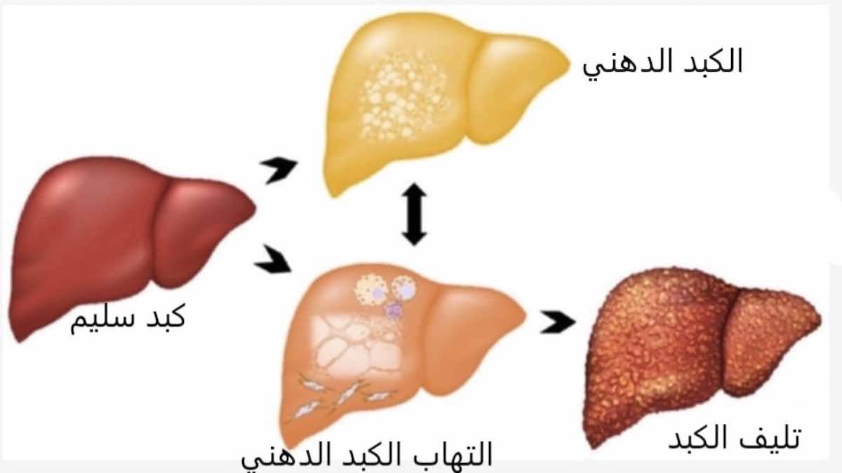 تشحم الكبد ومضاعفاته - الكبد الدهني