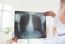 بريطانيا تبدأ تقديم دواء جديد ناجح لمرضى سرطان الرئة