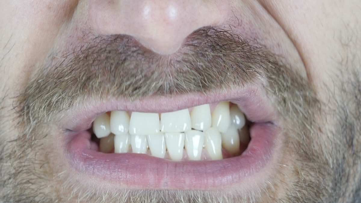 صرير الاسنان | كيف يحدث؟ و 6 أسباب تزيد احتمالات حدوثه