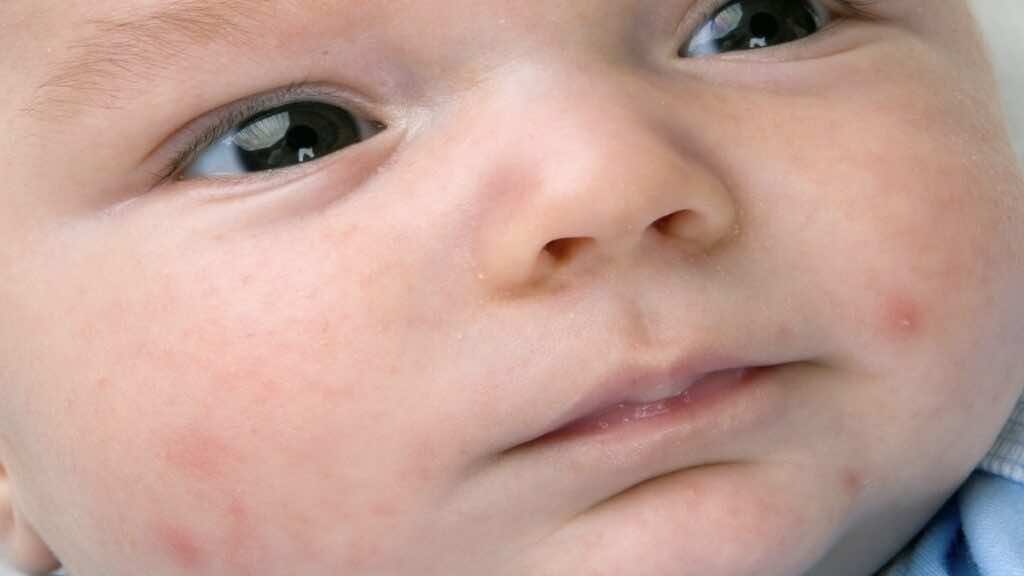 حب الوجه في الاطفال الرضع Baby acne
