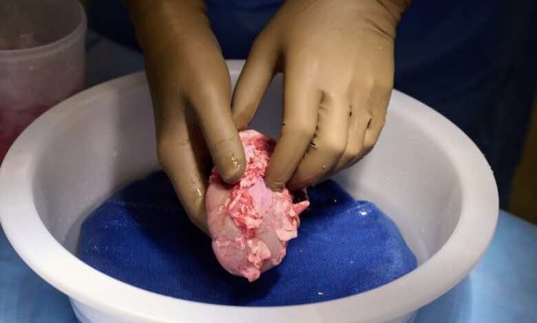 كلية الخنزير يتم تجهيزها للزراعة في جسم المريضة