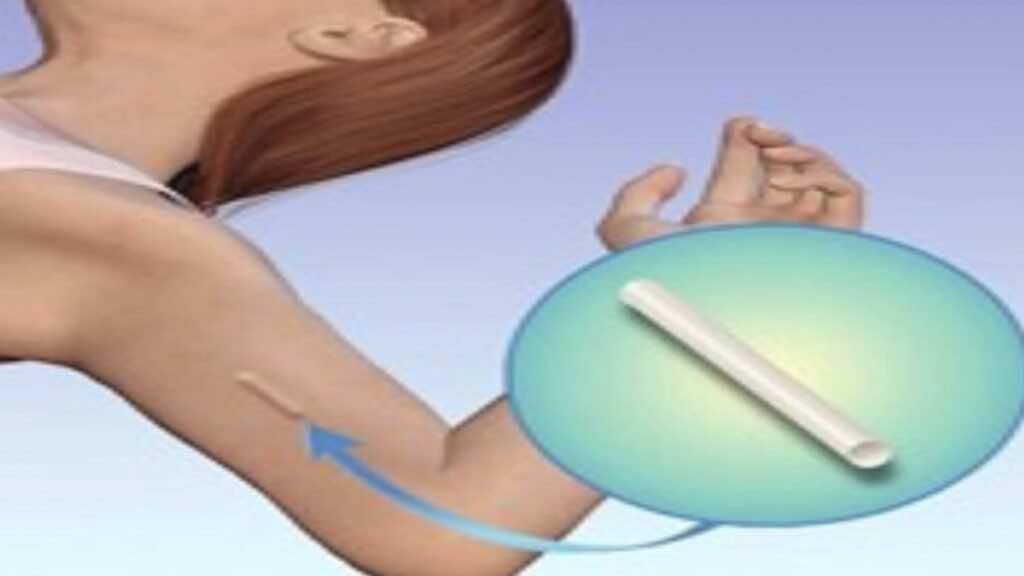 غرسات منع الحمل -وسائل منع الحمل