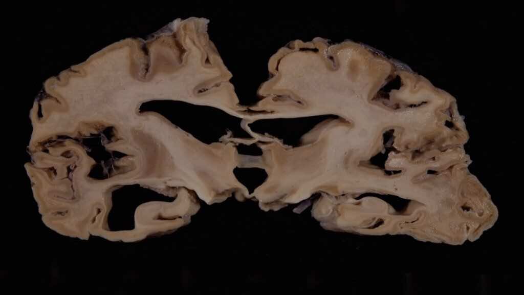 يسبب التلف في حالة مرض كروتزفيلد جاكوب (ومرض جنون البقر) ظهور تجاويف صغيرة في المخ، وذلك يعطيه شكل الاسفنج