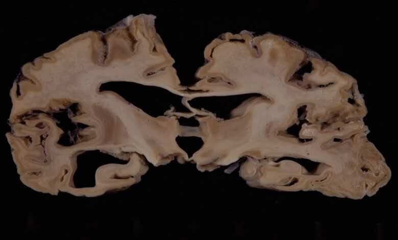 يسبب التلف في حالة مرض كروتزفيلد جاكوب (ومرض جنون البقر) ظهور تجاويف صغيرة في المخ، وذلك يعطيه شكل الاسفنج