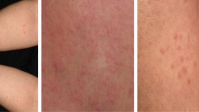 5 خطوات ل علاج الارتيكاريا  الكولينيرجية التي يسببها التعرق - الطفح الجلدي